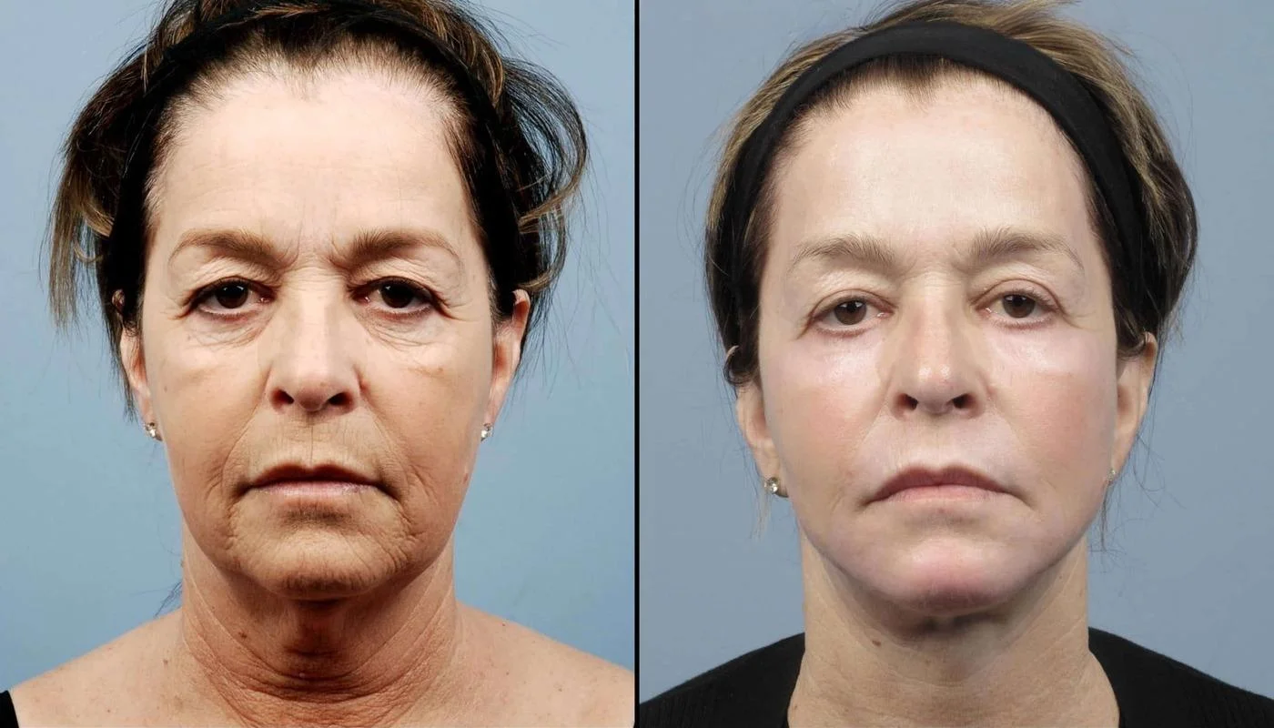 Facetite - Before and After Gallery - Patient Photo 77