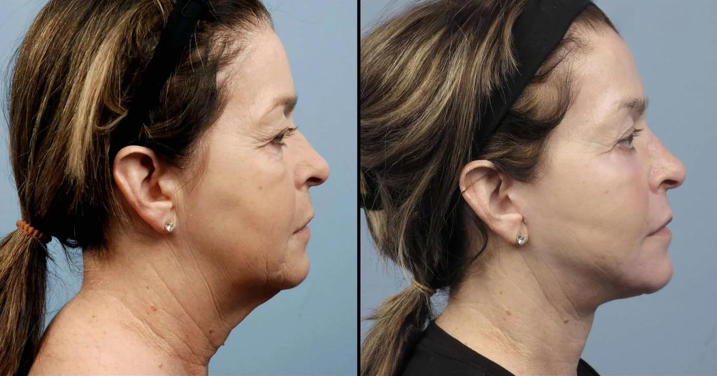 Facetite - Before and After Gallery - Patient Photo 79