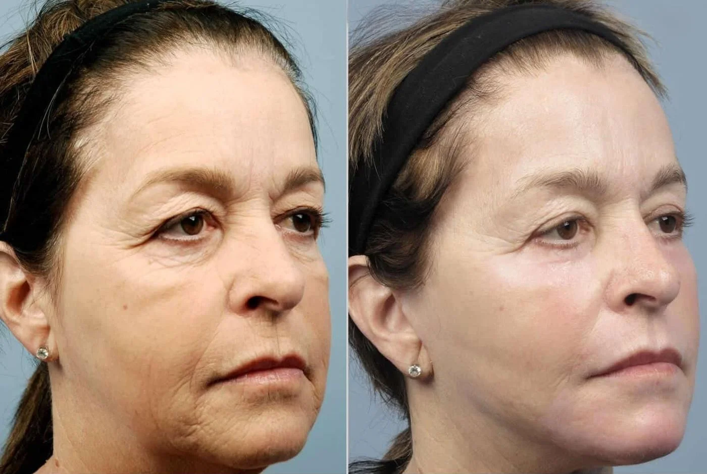 Facetite - Before and After Gallery - Patient Photo 80