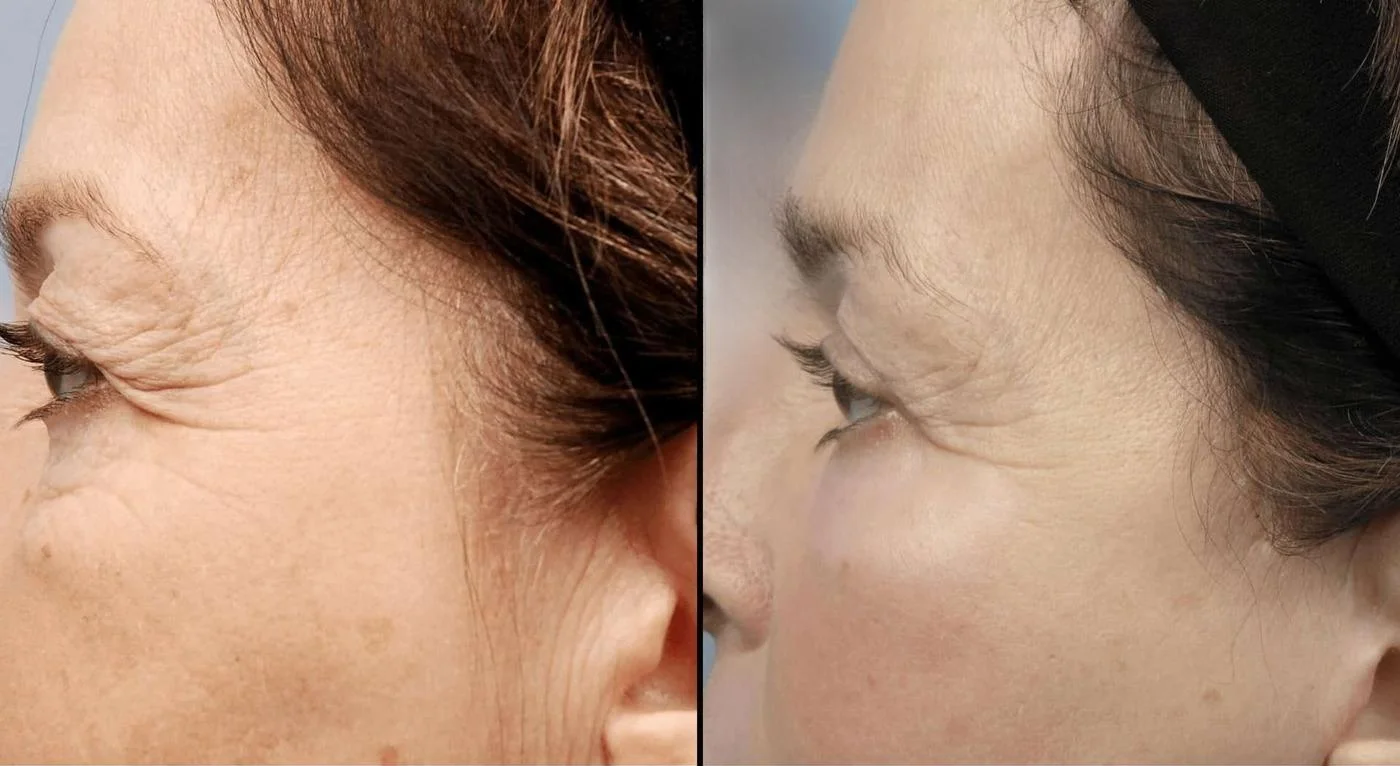 Facetite - Before and After Gallery - Patient Photo 81