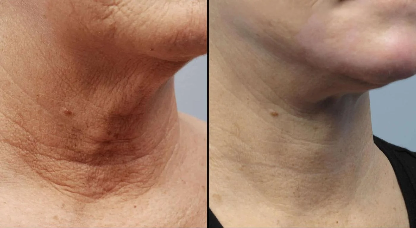 Facetite - Before and After Gallery - Patient Photo 87