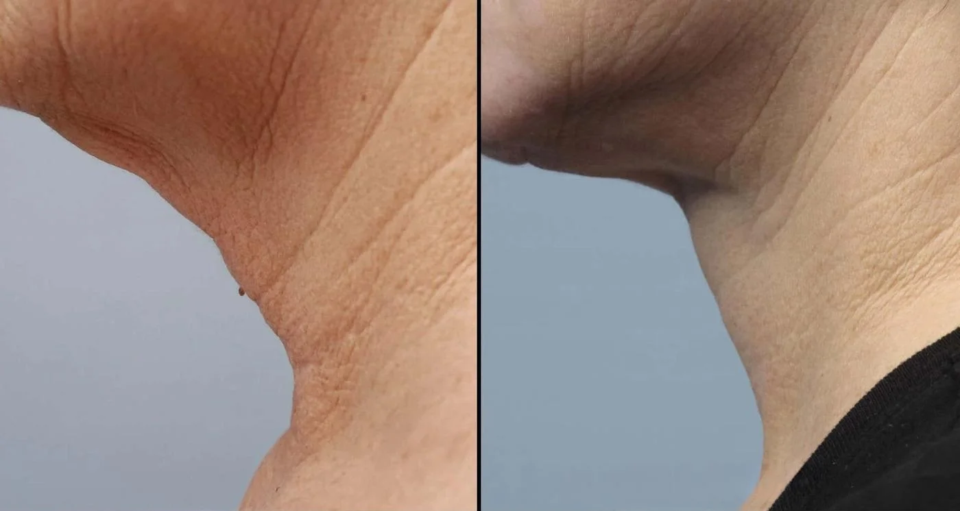 Facetite - Before and After Gallery - Patient Photo 88