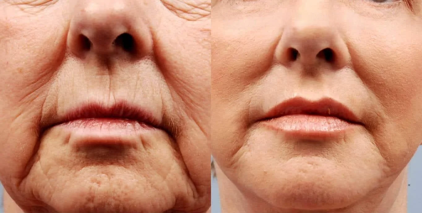 Facetite - Before and After Gallery - Patient Photo 9