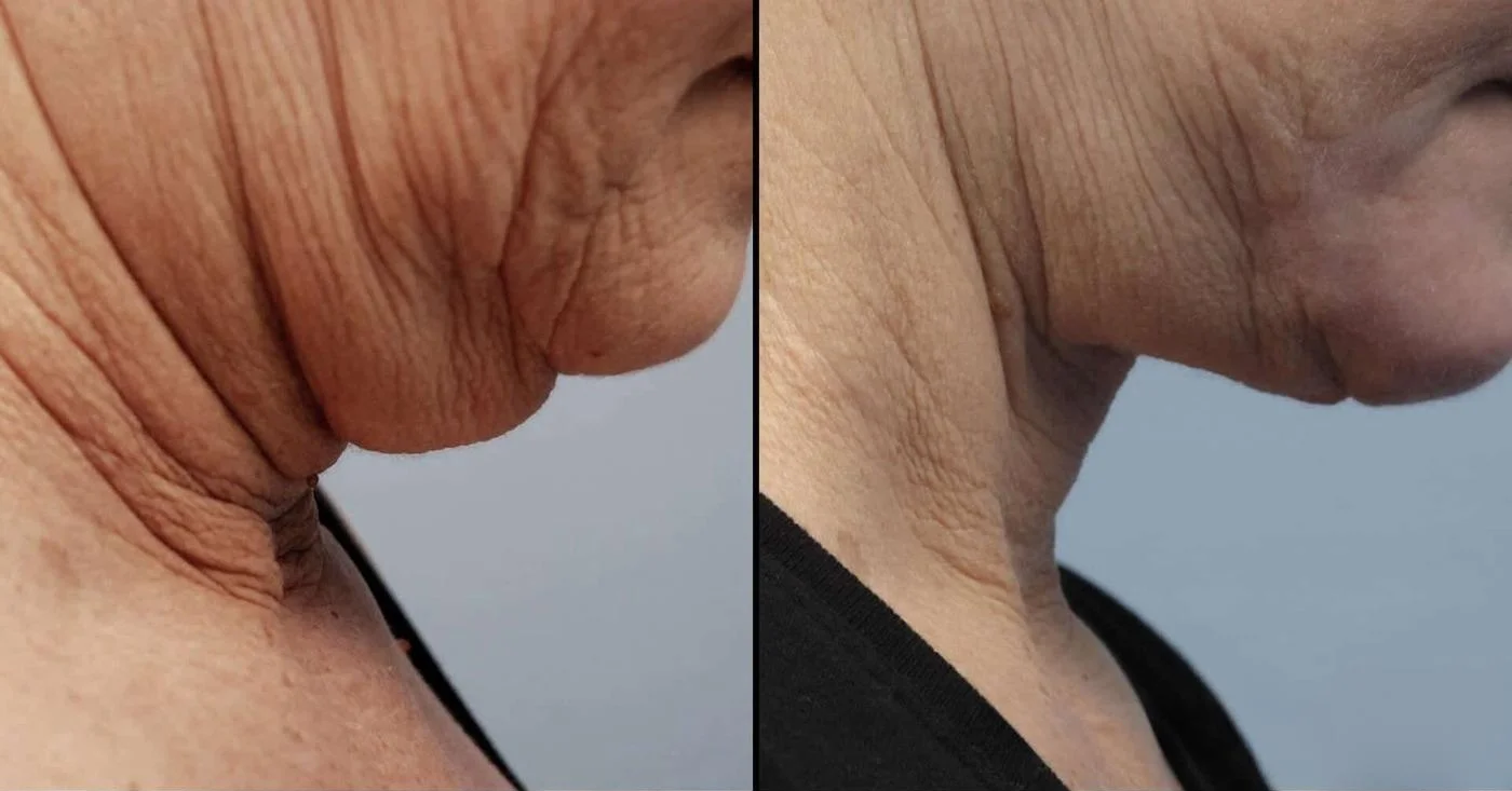 Facetite - Before and After Gallery - Patient Photo 90