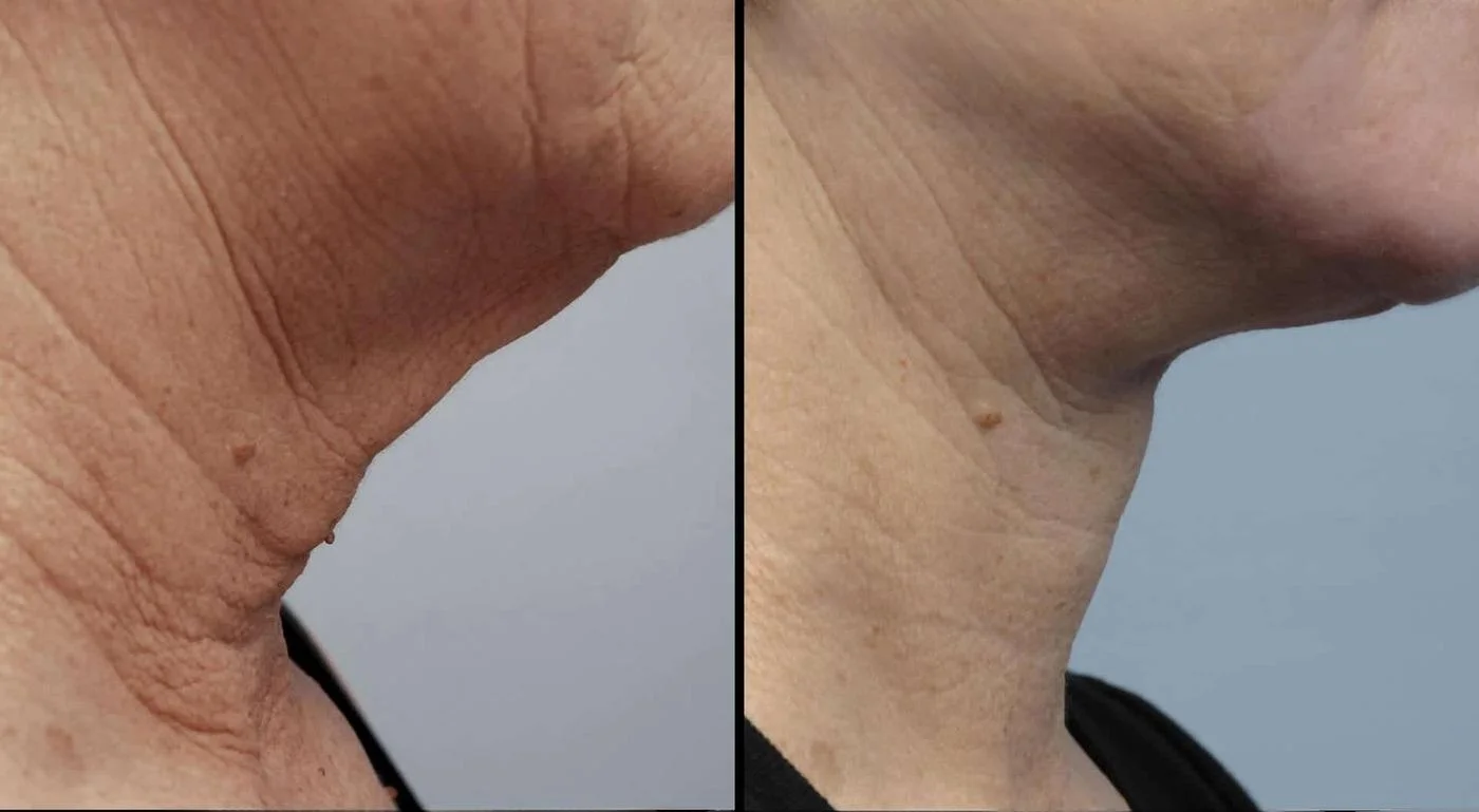 Facetite - Before and After Gallery - Patient Photo 91