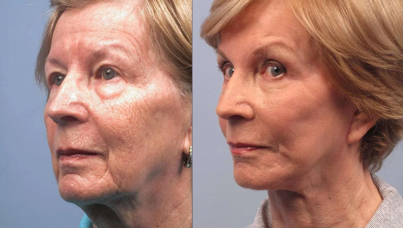 Facetite - Before and After Gallery - Patient Photo 94