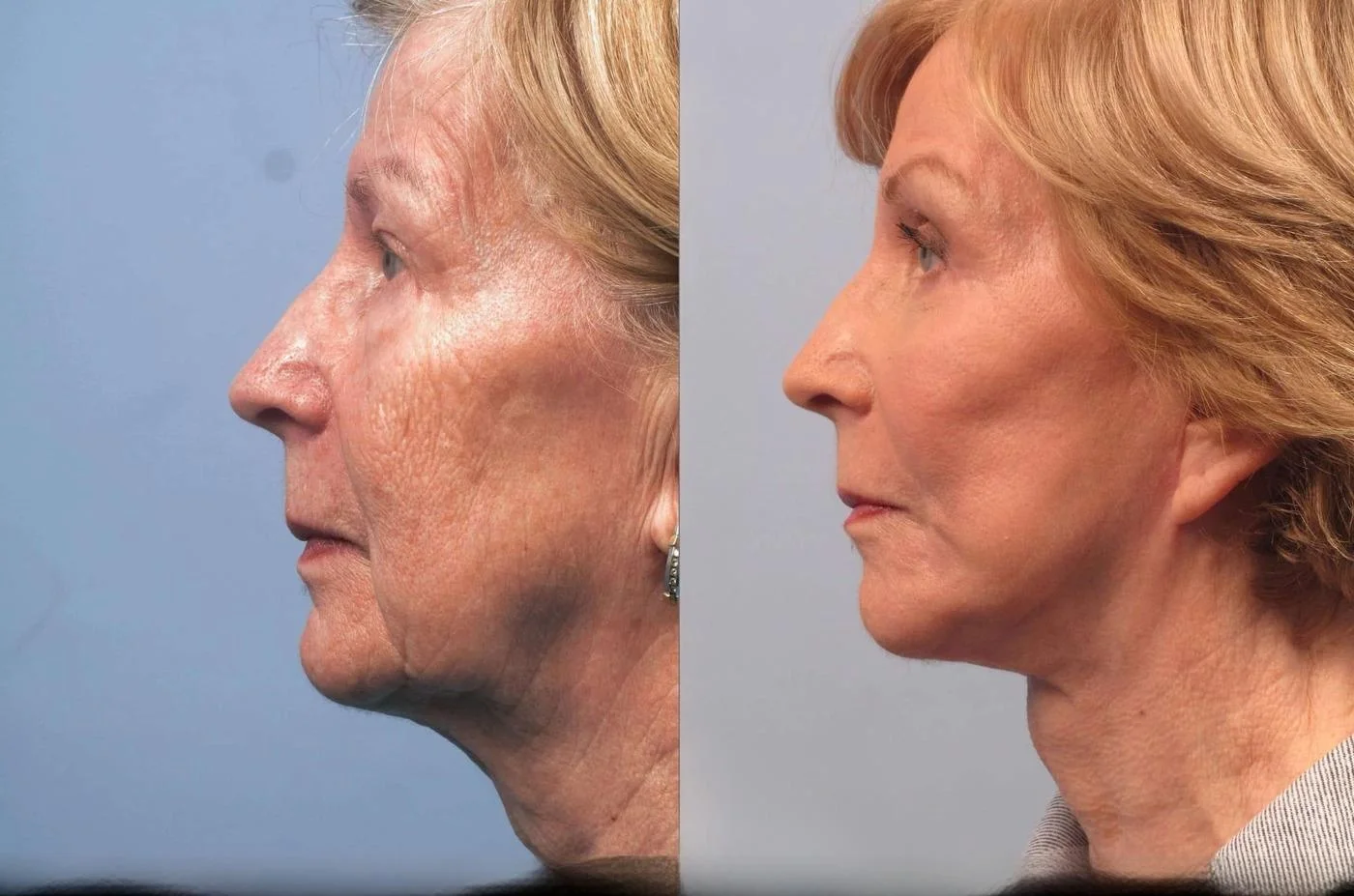 Facetite - Before and After Gallery - Patient Photo 95