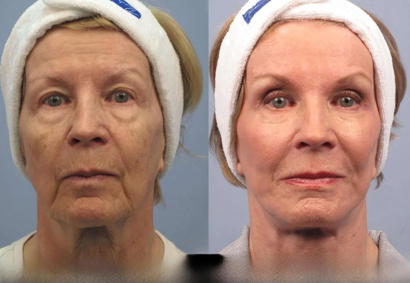 Facetite - Before and After Gallery - Patient Photo 96