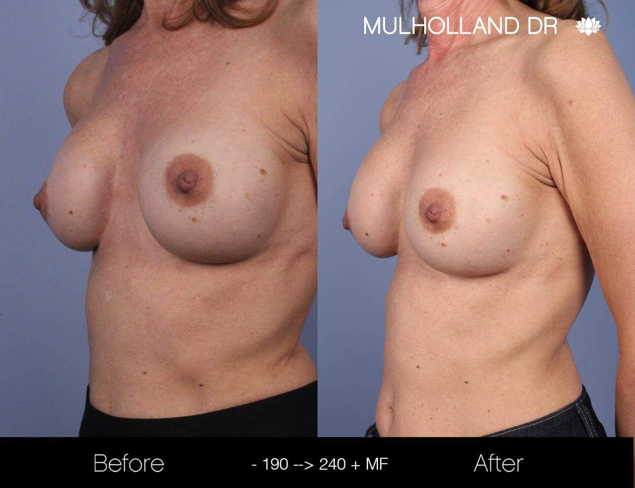 Fat Transfer Breast Augmentation - Before and After Gallery - Patient Photo 17