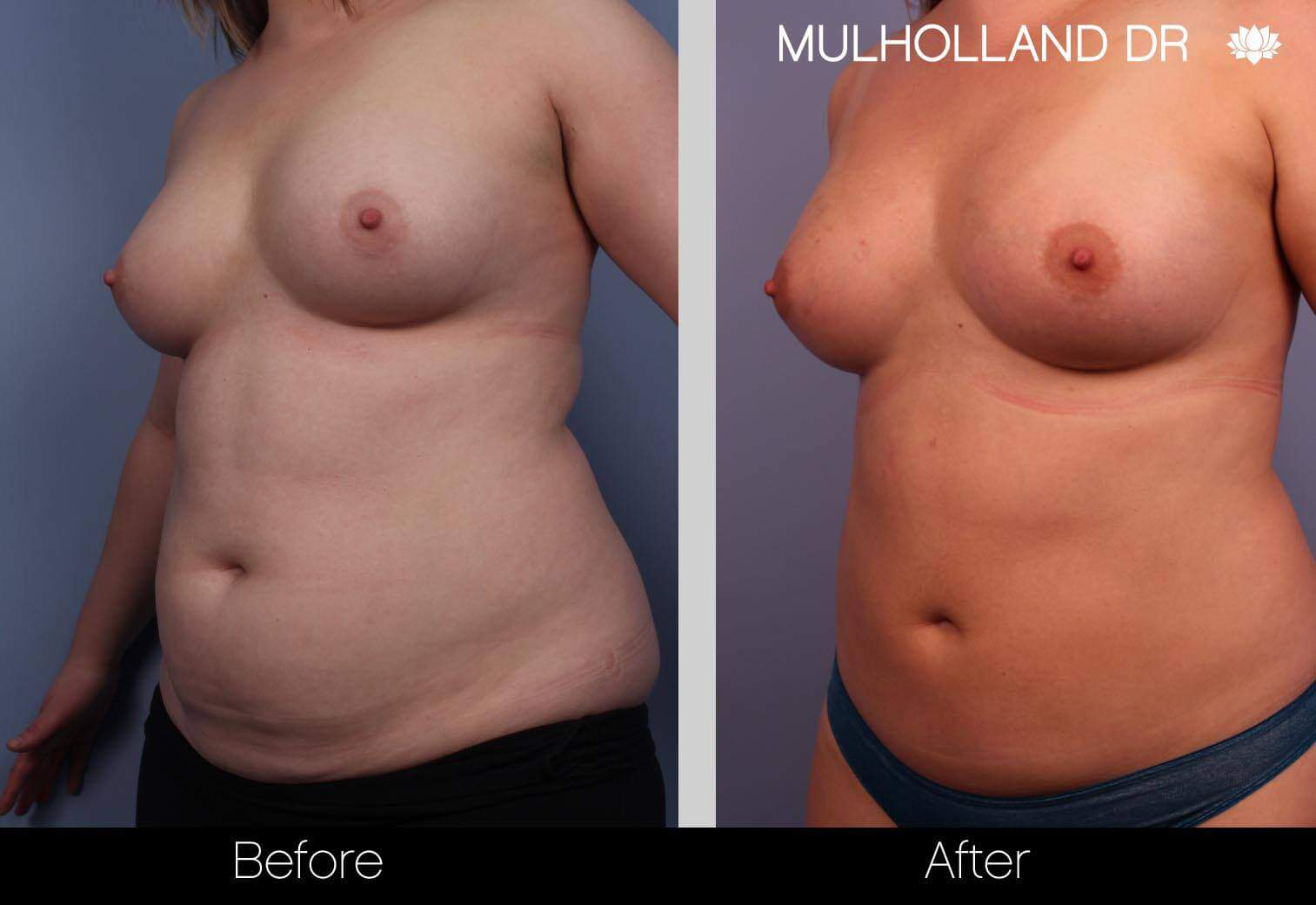 Fat Transfer Breast Augmentation - Before and After Gallery - Patient Photo 2