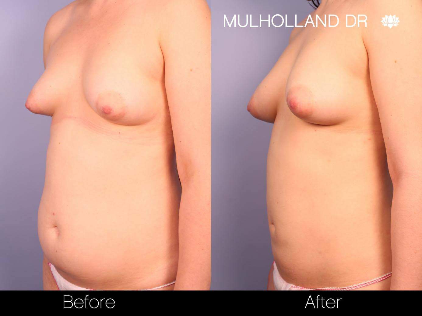 Fat Transfer Breast Augmentation - Before and After Gallery - Patient Photo 22