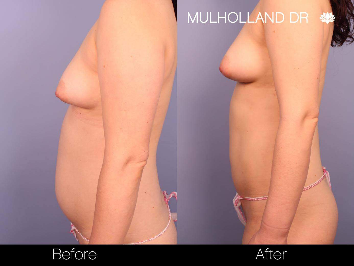 Fat Transfer Breast Augmentation - Before and After Gallery - Patient Photo 23