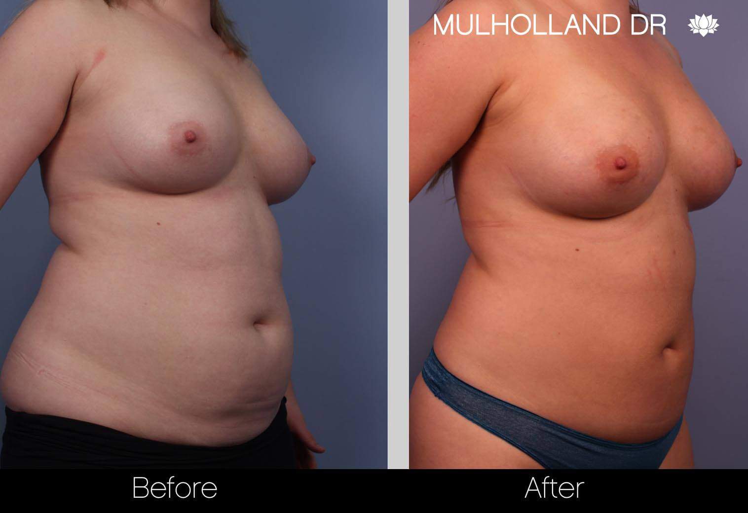 Fat Transfer Breast Augmentation - Before and After Gallery - Patient Photo 4