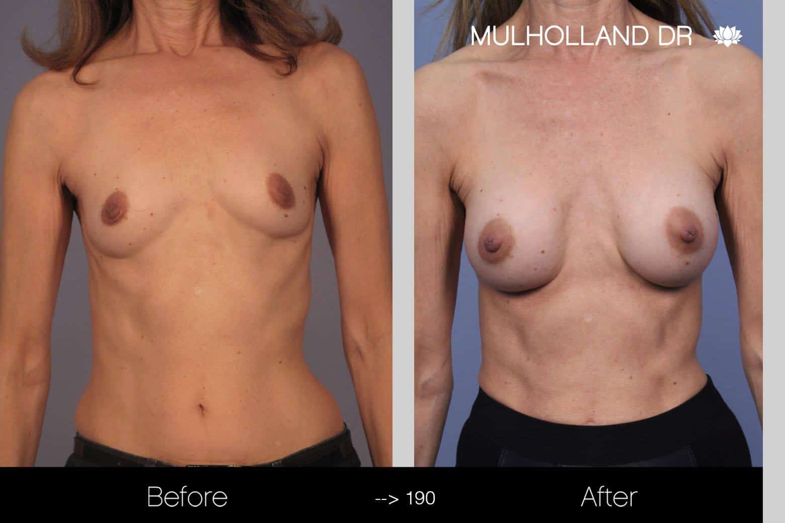 Fat Transfer Breast Augmentation - Before and After Gallery - Patient Photo 6