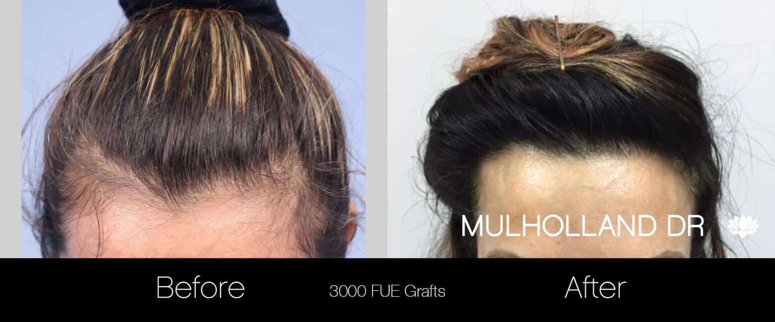 Looks Studio  Female Hair Transplant