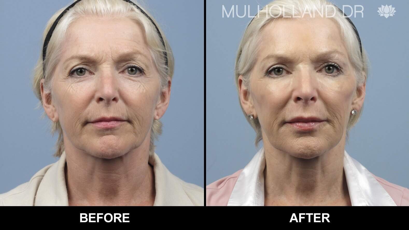 Fractional CO2 - Before and After Gallery - Patient Photo 1