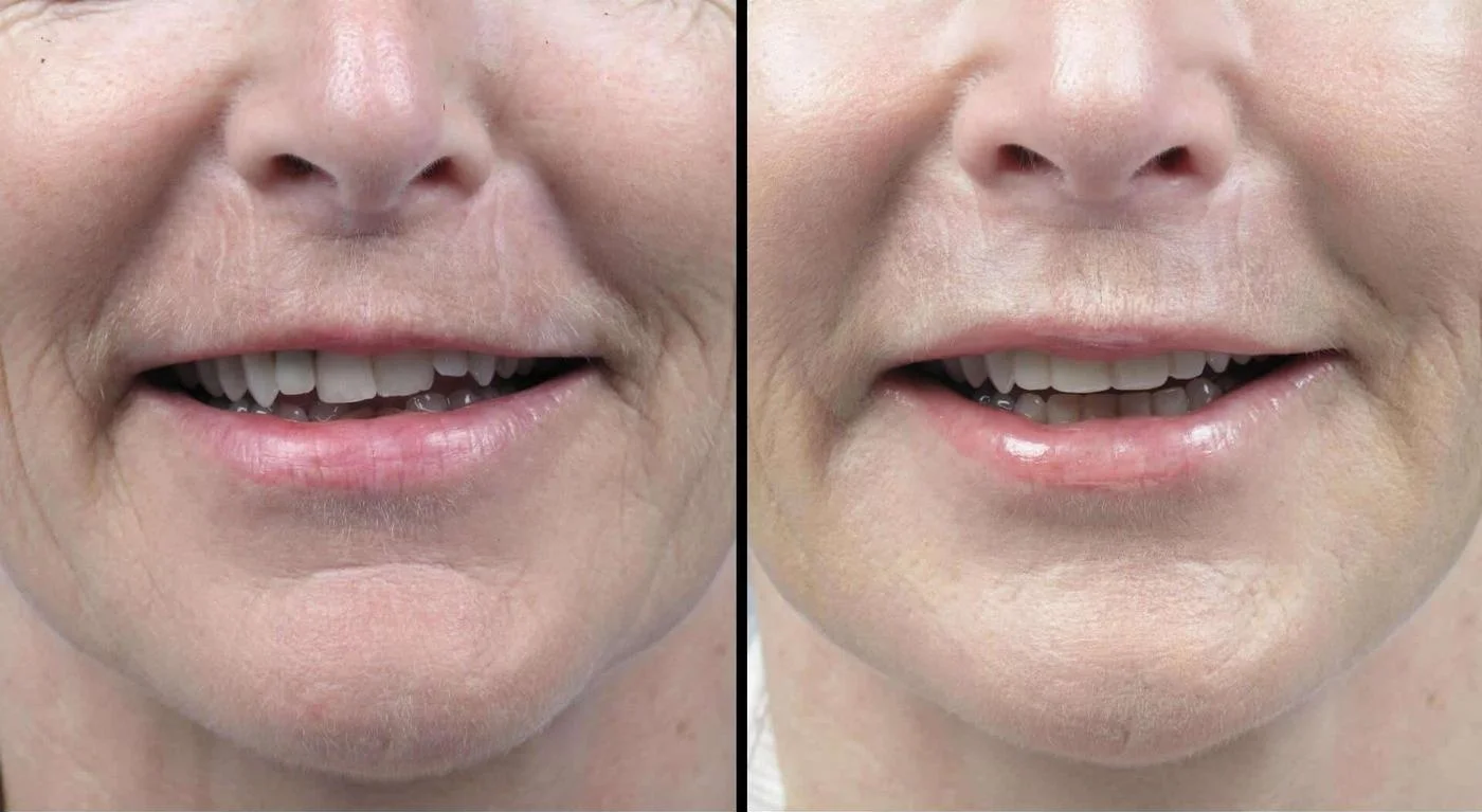 Fractional CO2 - Before and After Gallery - Patient Photo 10