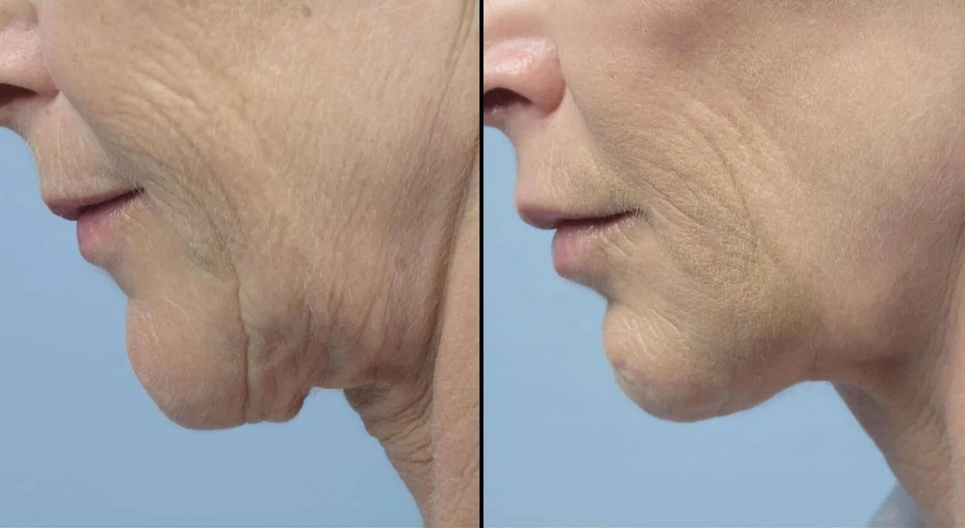 Fractional CO2 - Before and After Gallery - Patient Photo 11