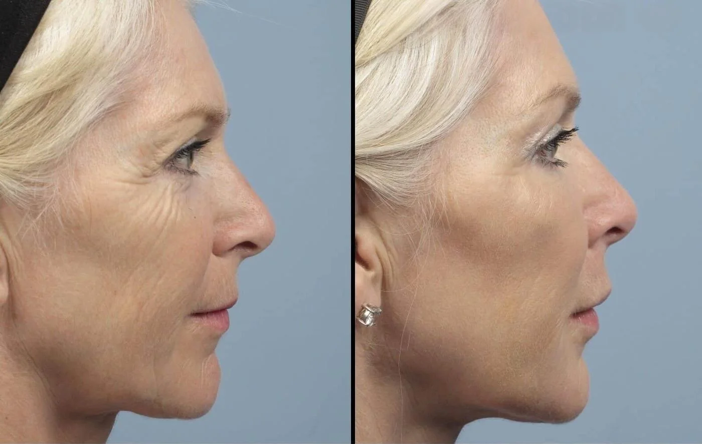 Fractional CO2 - Before and After Gallery - Patient Photo 12