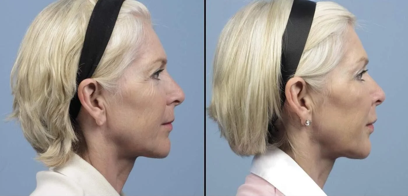 Fractional CO2 - Before and After Gallery - Patient Photo 13