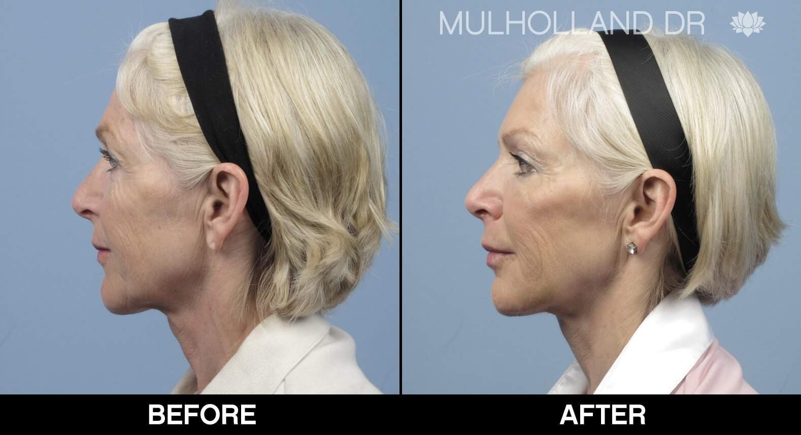 Fractional CO2 - Before and After Gallery - Patient Photo 17