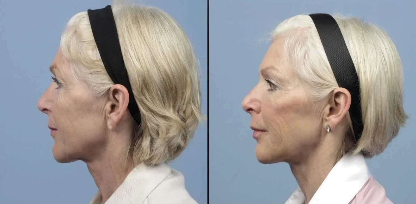 Fractional CO2 - Before and After Gallery - Patient Photo 17