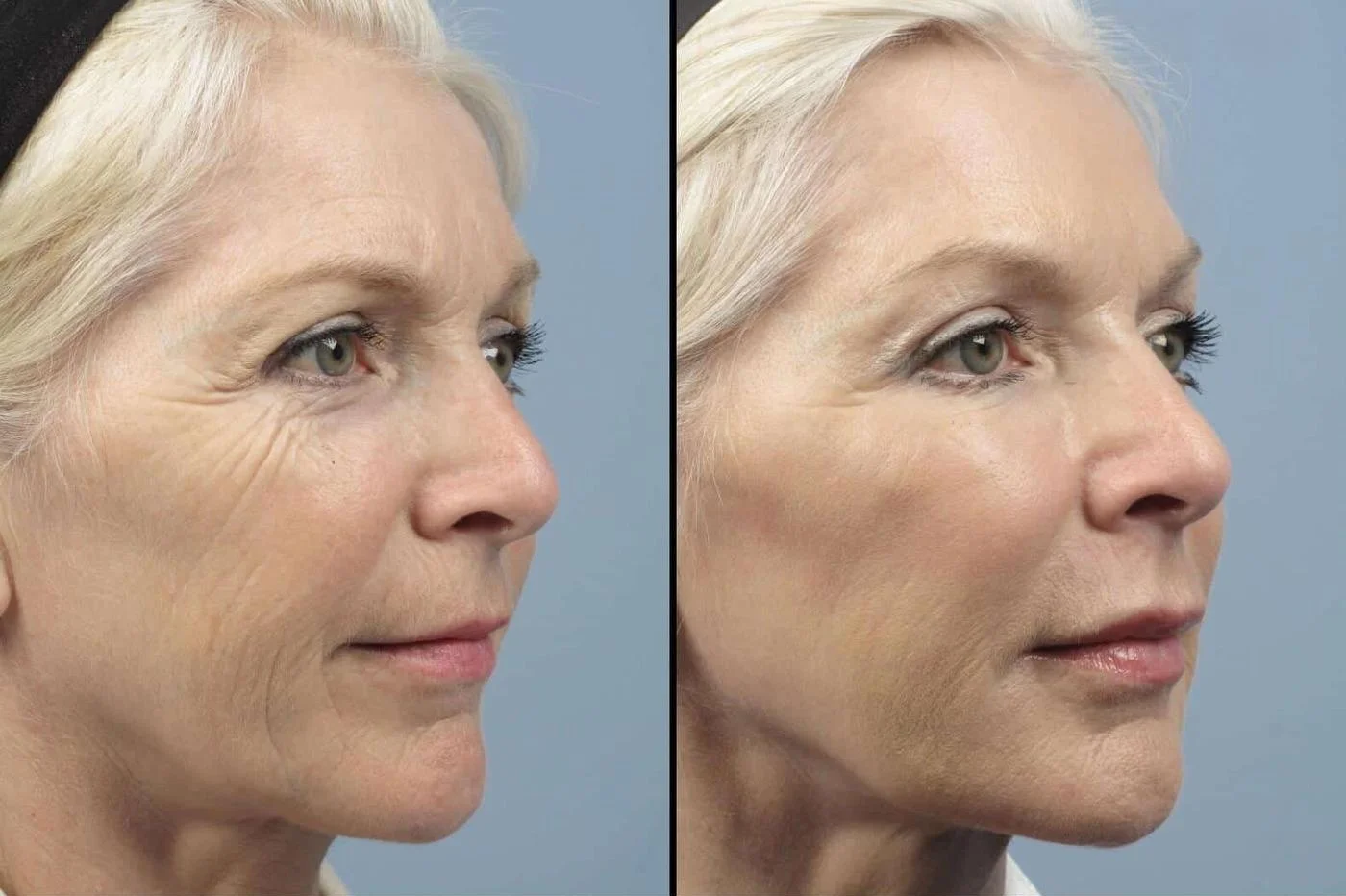 Fractional CO2 - Before and After Gallery - Patient Photo 3