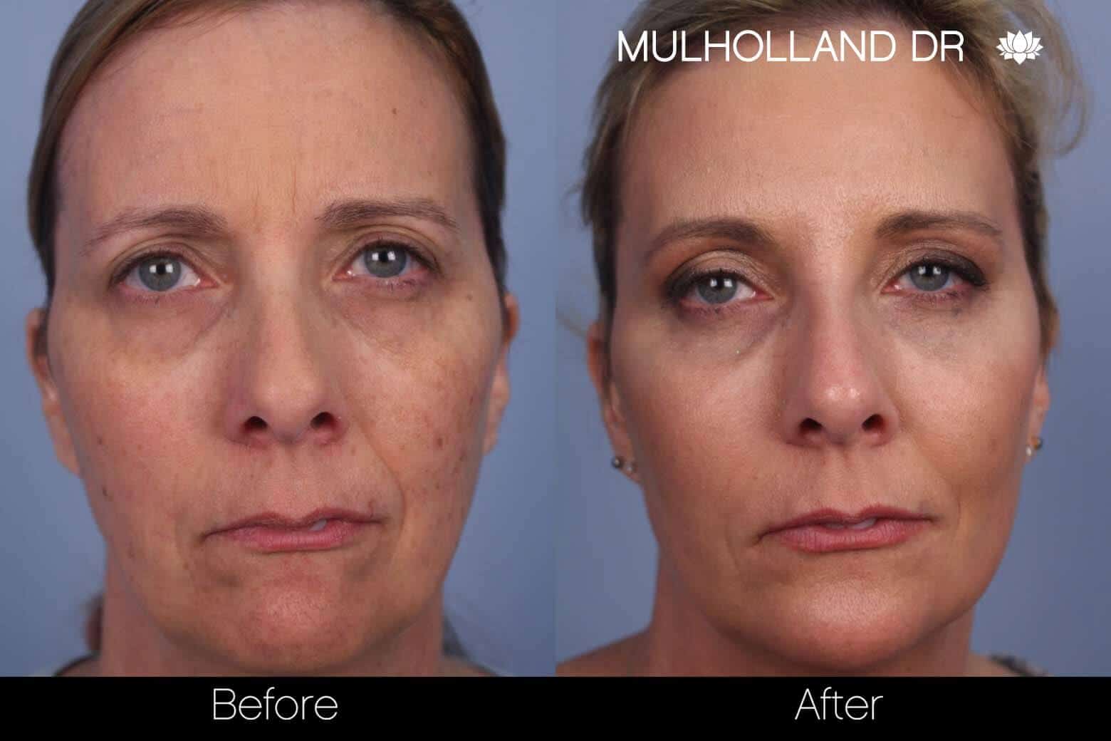 Fractional CO2 - Before and After Gallery - Patient Photo 31