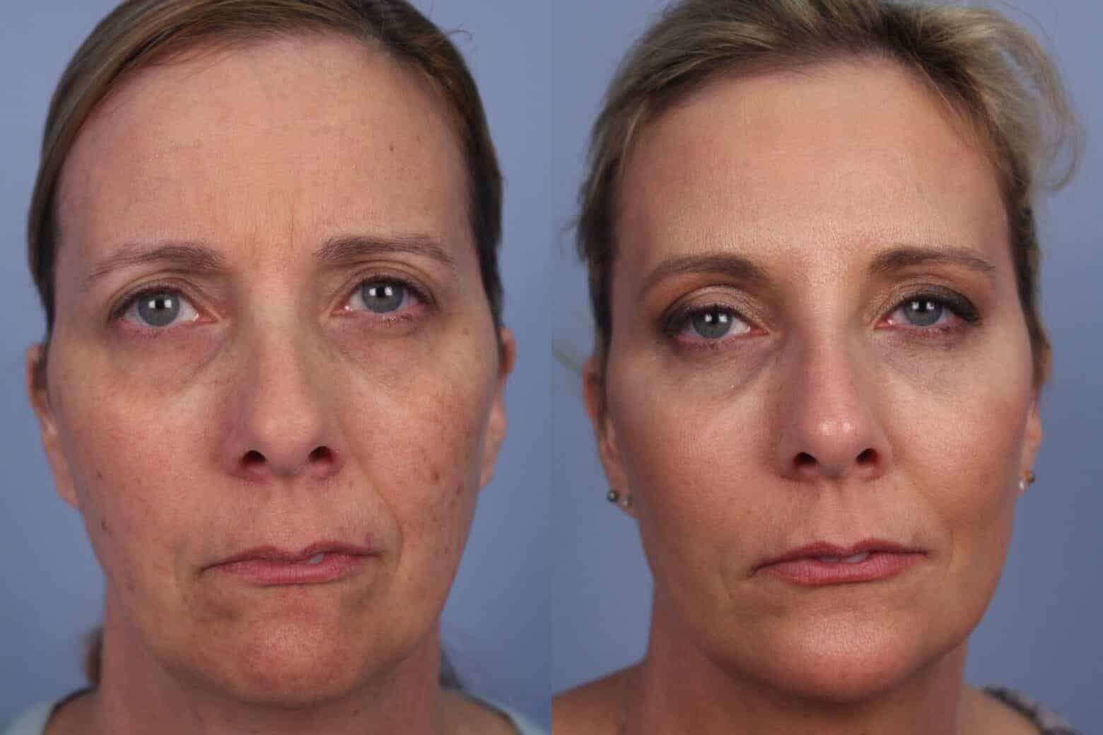 Fractional CO2 - Before and After Gallery - Patient Photo 32