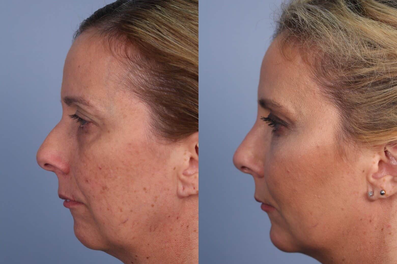 Fractional CO2 - Before and After Gallery - Patient Photo 42