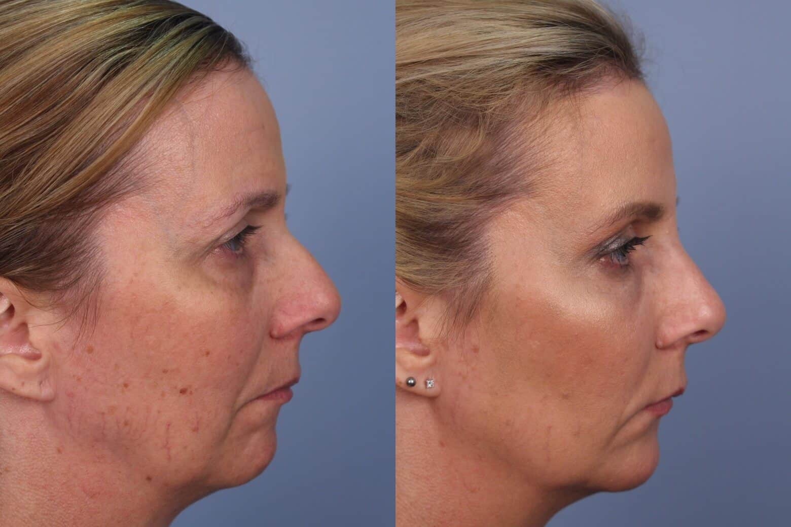 Fractional CO2 - Before and After Gallery - Patient Photo 44