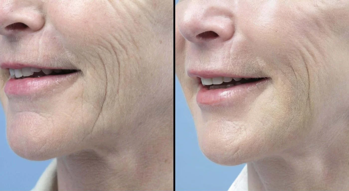 Fractional CO2 - Before and After Gallery - Patient Photo 5