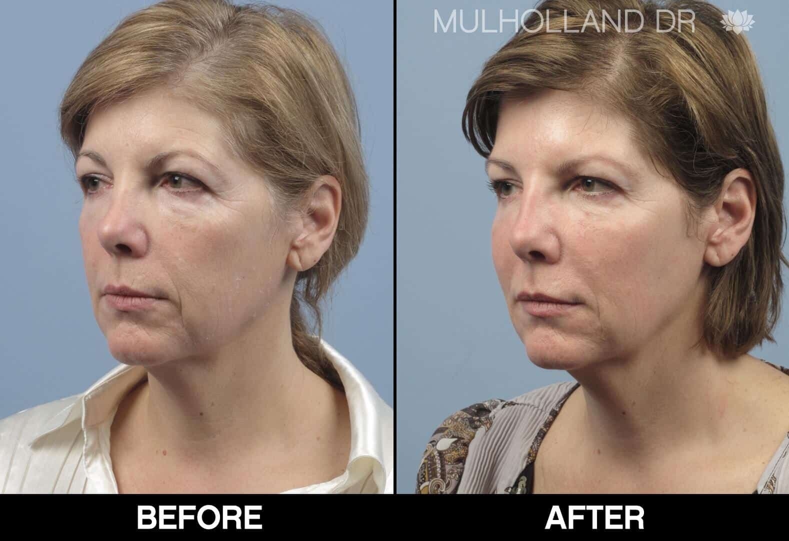 Fractional CO2 - Before and After Gallery - Patient Photo 55