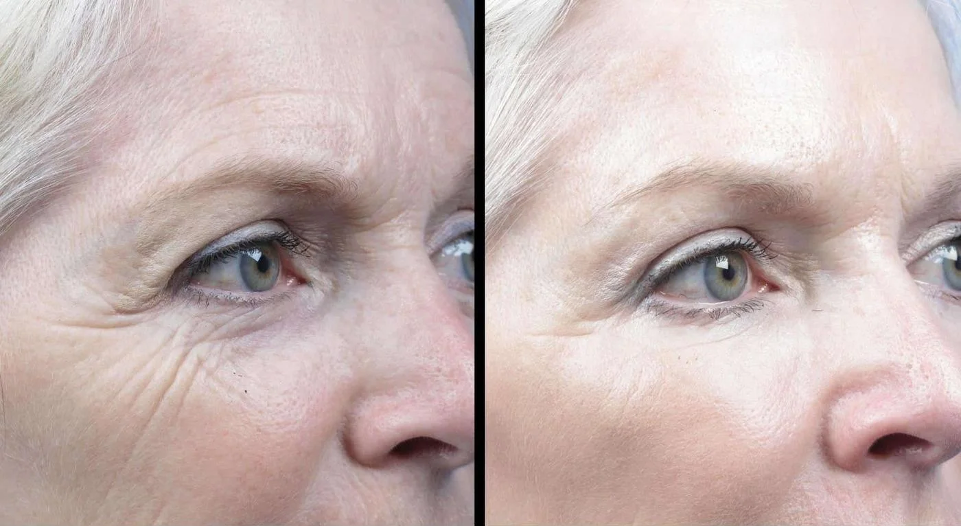 Fractional CO2 - Before and After Gallery - Patient Photo 6