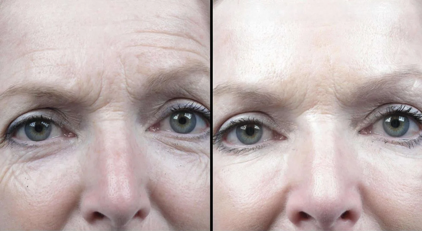 Fractional CO2 - Before and After Gallery - Patient Photo 8