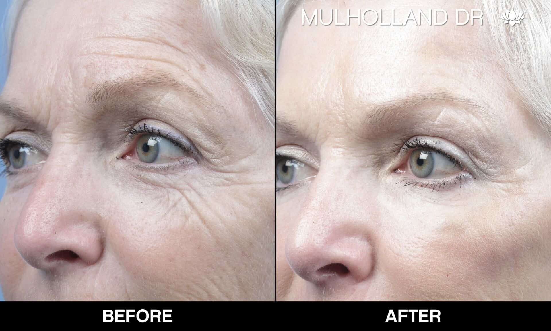 Fractional Erbium Laser - Before and After Gallery - Patient Photo 14