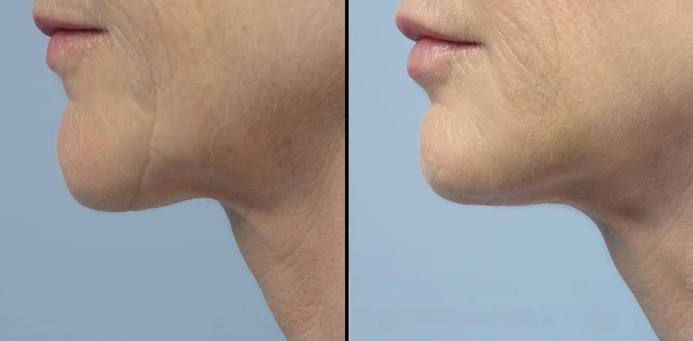 Fractional Erbium Laser - Before and After Gallery - Patient Photo 16