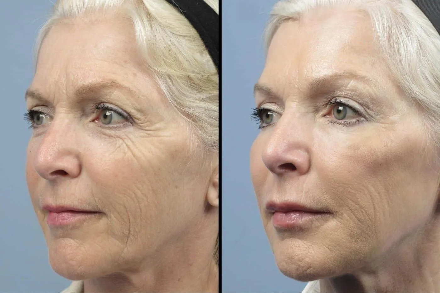 Fractional Erbium Laser - Before and After Gallery - Patient Photo 2