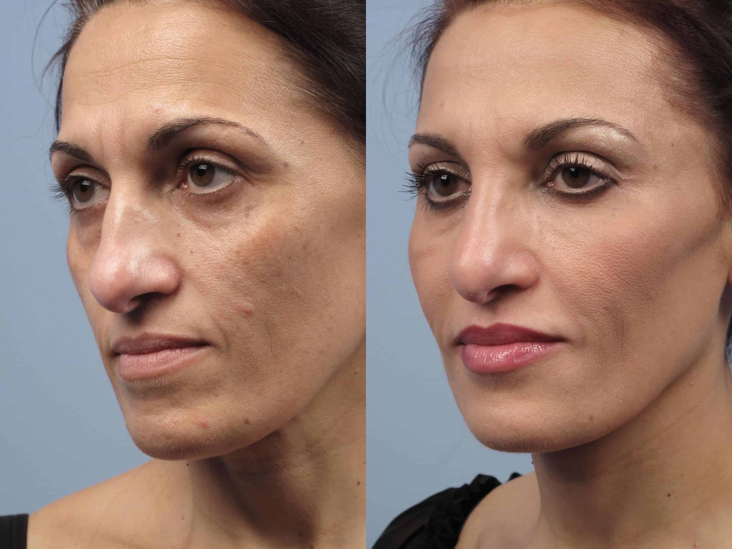 Fractional Erbium Laser - Before and After Gallery - Patient Photo 21