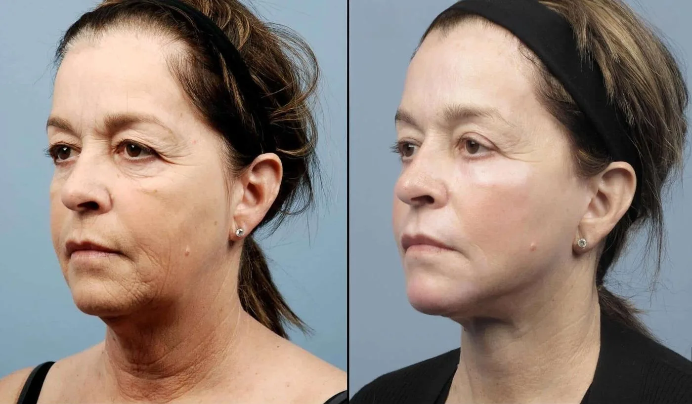 Fractional Erbium Laser - Before and After Gallery - Patient Photo 23