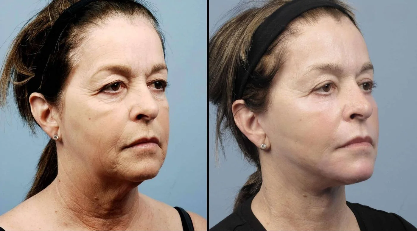 Fractional Erbium Laser - Before and After Gallery - Patient Photo 24