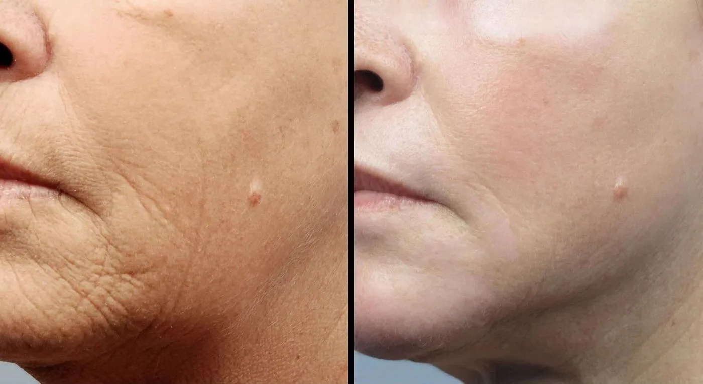 Fractional Erbium Laser - Before and After Gallery - Patient Photo 25