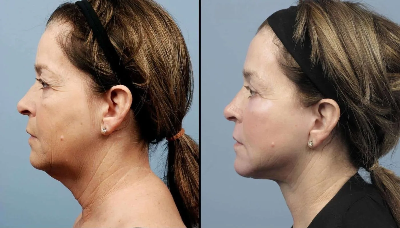 Fractional Erbium Laser - Before and After Gallery - Patient Photo 28
