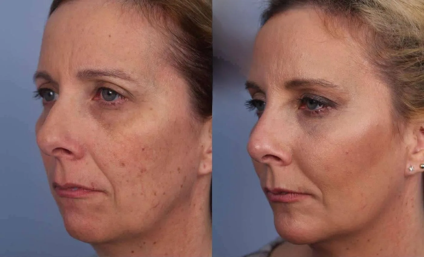 Fractional Erbium Laser - Before and After Gallery - Patient Photo 33