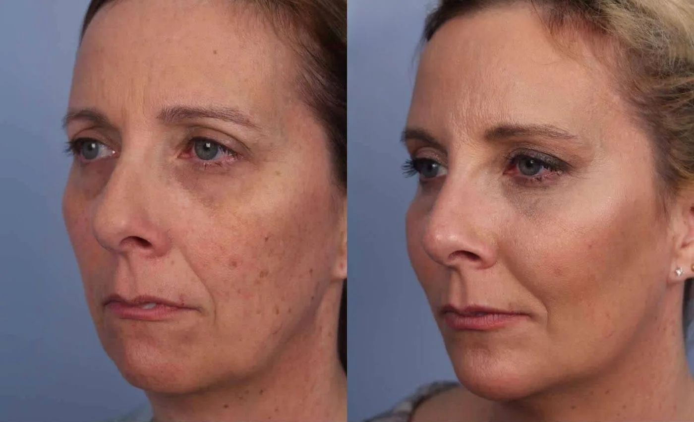 Fractional Erbium Laser - Before and After Gallery - Patient Photo 35
