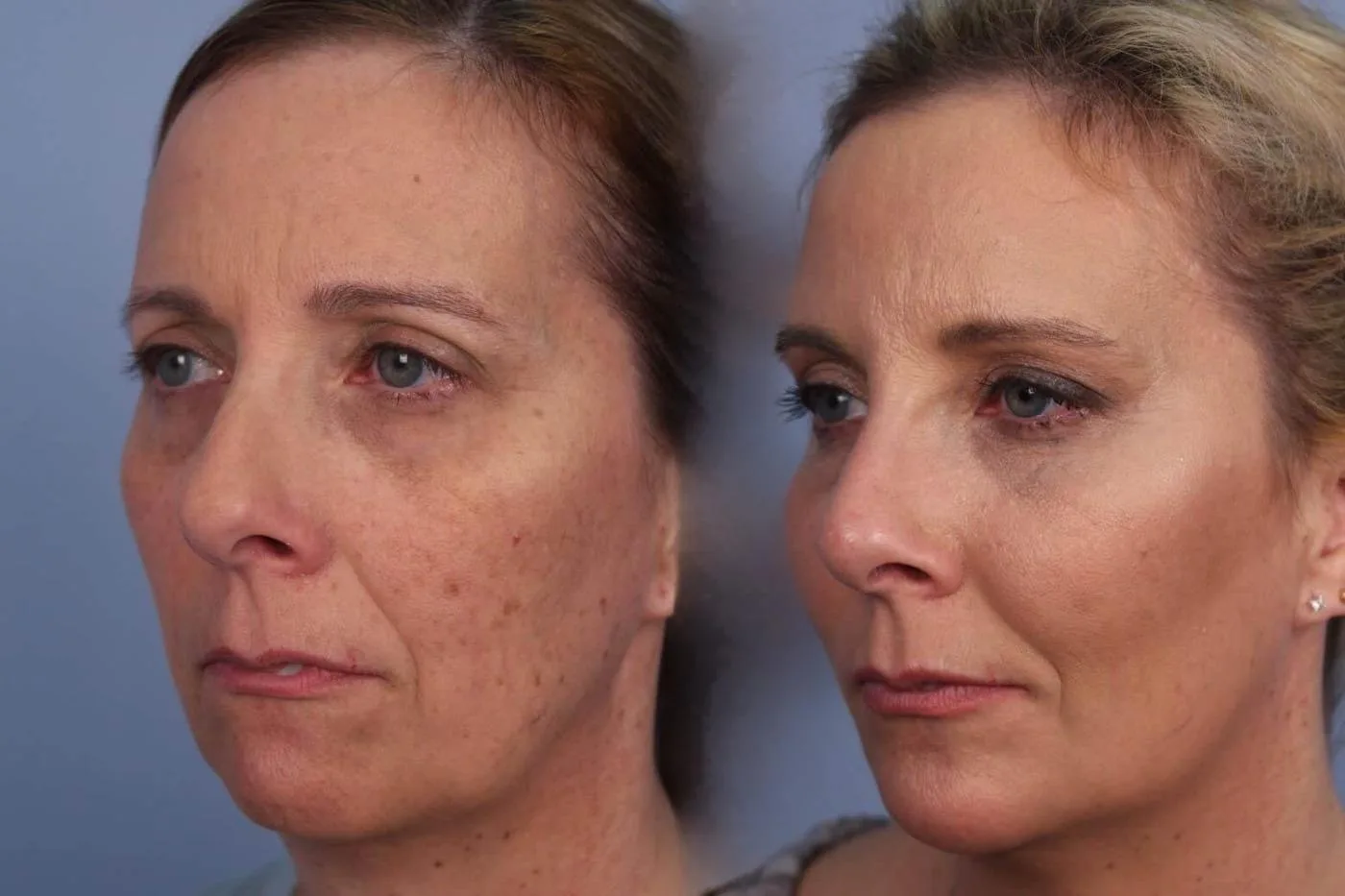 Fractional Erbium Laser - Before and After Gallery - Patient Photo 36