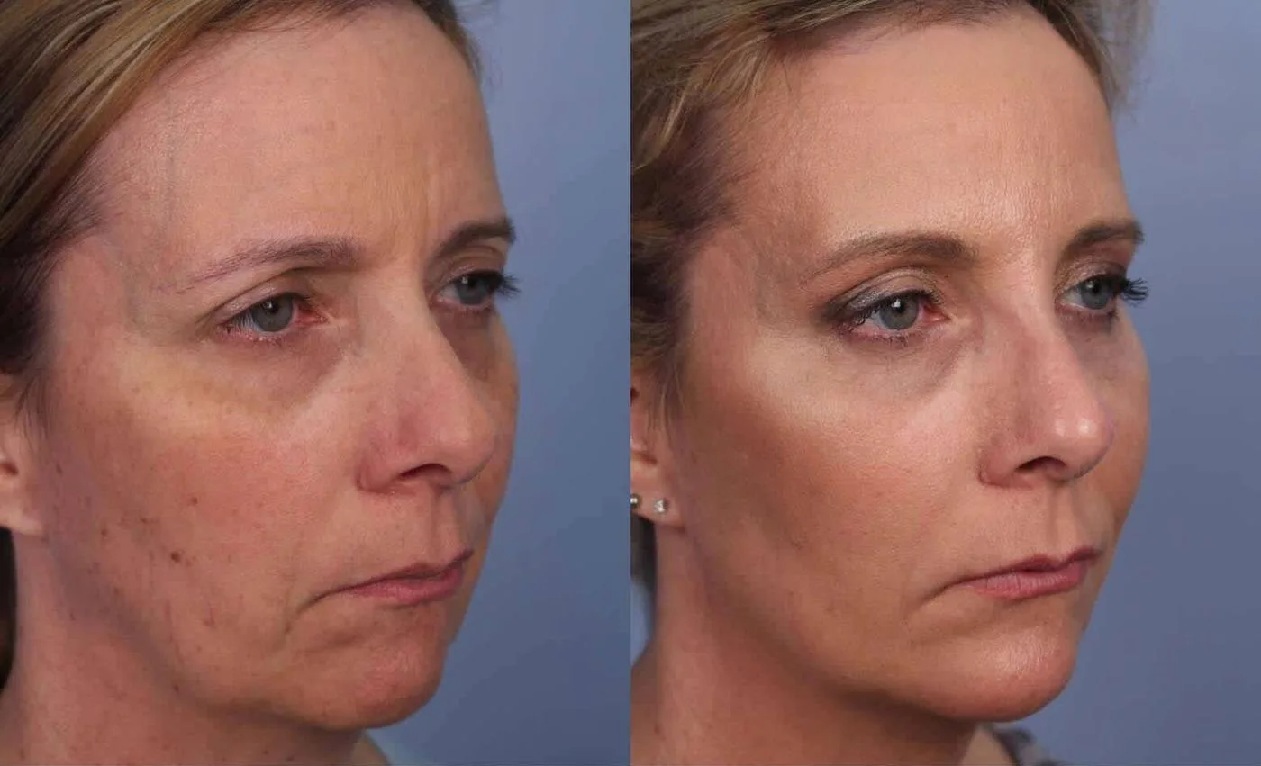 Fractional Erbium Laser - Before and After Gallery - Patient Photo 37