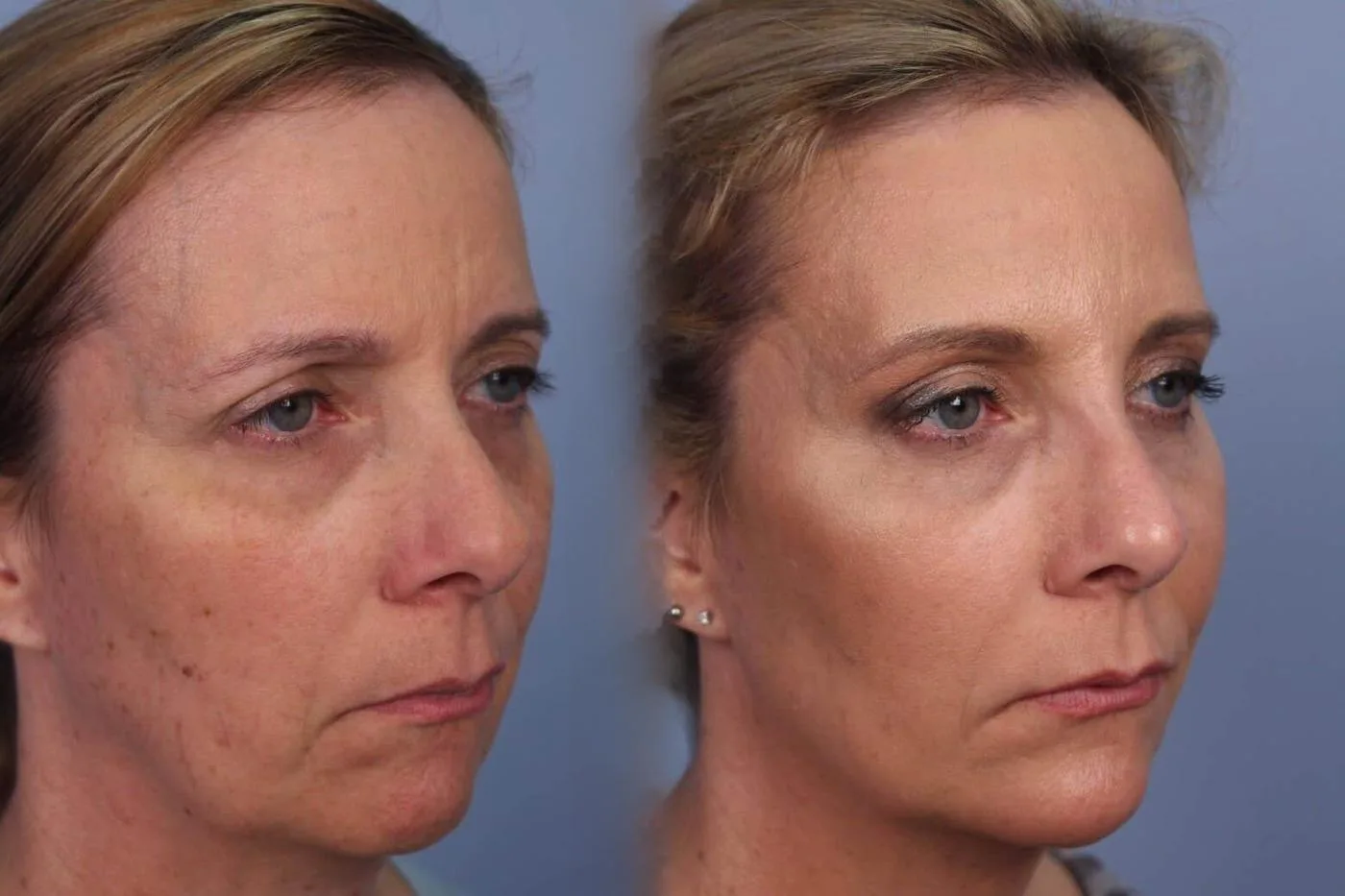 Fractional Erbium Laser - Before and After Gallery - Patient Photo 38