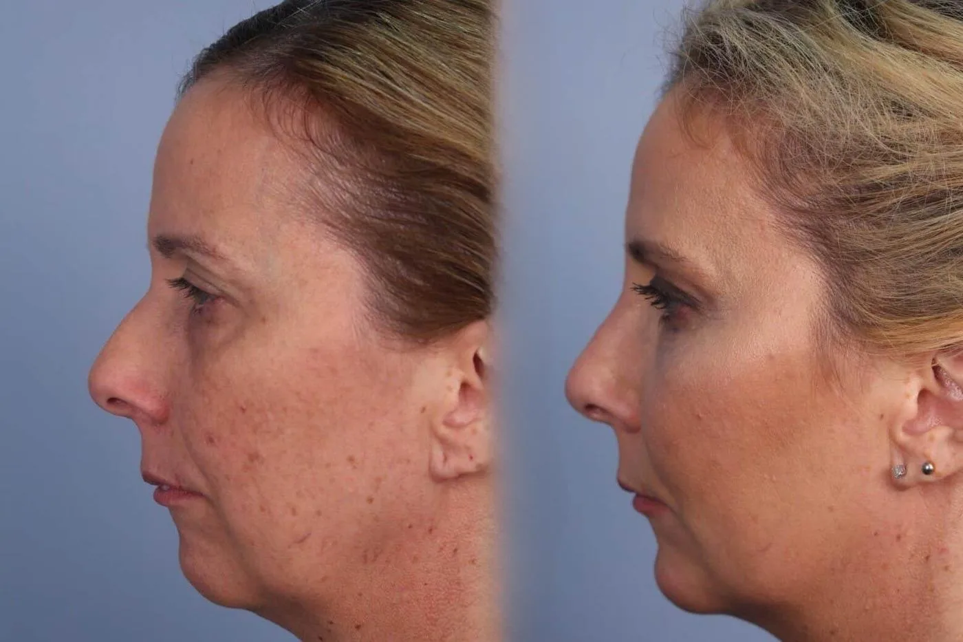 Fractional Erbium Laser - Before and After Gallery - Patient Photo 42