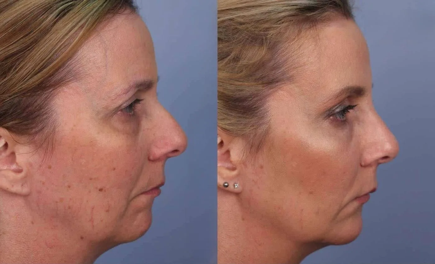 Fractional Erbium Laser - Before and After Gallery - Patient Photo 43
